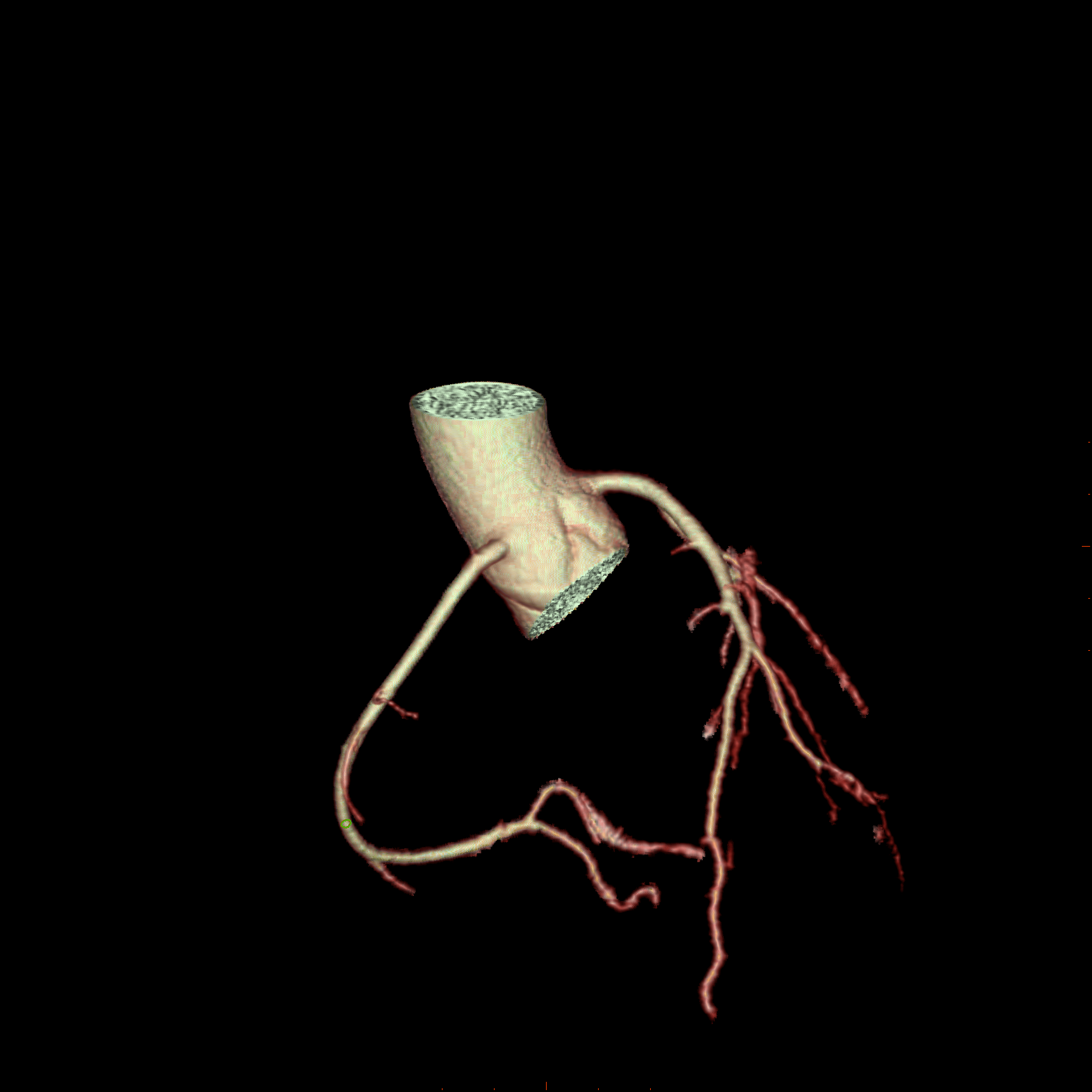 CT-Aufnahme der Herzkranzgefäße – 3D-Darstellung