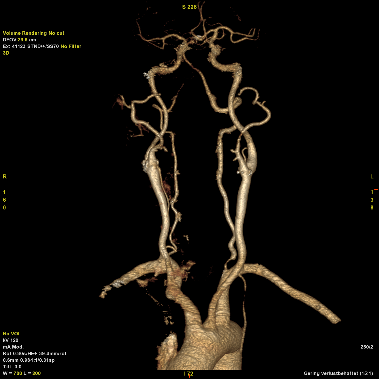 CT-Angiografie der Halsschlagadern – 3D-Darstellung