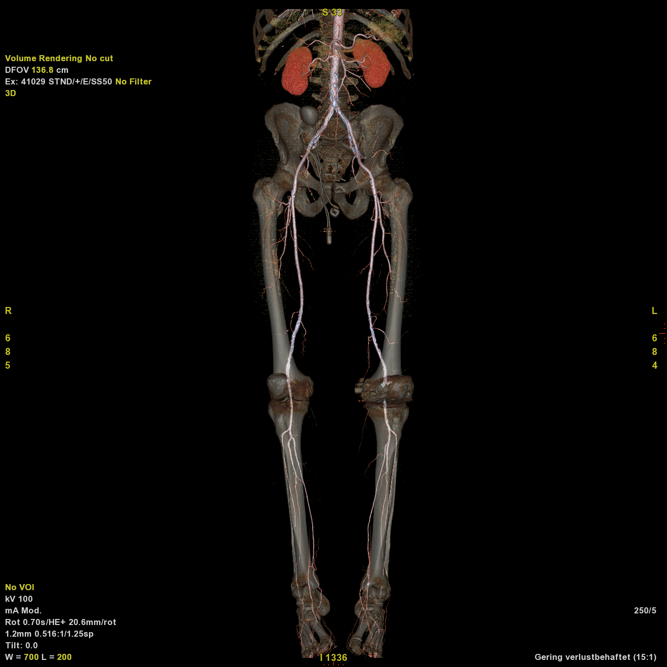 CT-Angiografie der Becken- und Beingefäße – 3D-Darstellung