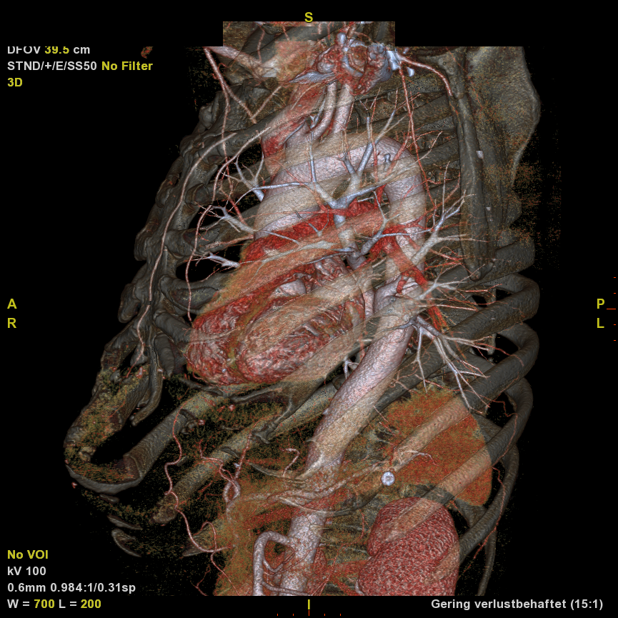 CT-Aufnahme der Aorta – 3D-Darstellung