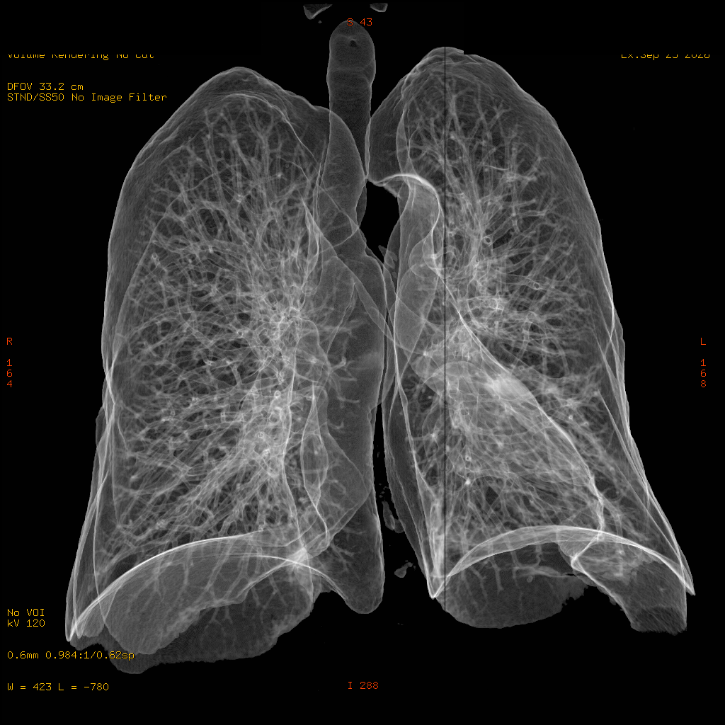 CT-Aufnahme der Lunge – transparente 3D-Darstellung